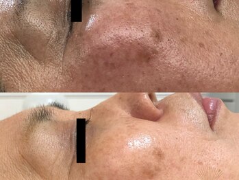 エイプリル/【ハーブピーリング】比較写真