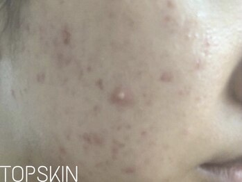 トップスキン 栄(TOPSKIN)/繰り返しニキビ終わらせます。