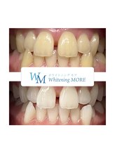 ホワイトニング モア(Whitening MORE)/ビフォーアフター