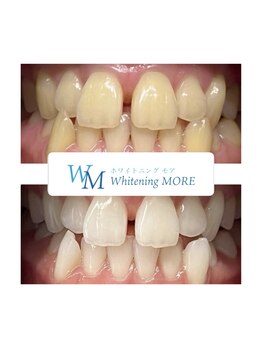 ホワイトニング モア(Whitening MORE)/ビフォーアフター