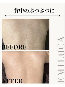 エミルカ 自由が丘店(EMILUCA)/背中のざらつきに