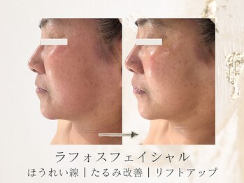 アネラボーテ(Anela Beaute)/ラフォスフェイシャル1回目