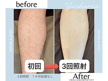 ユシェリア(Yucheria)/メンズひざ下脱毛