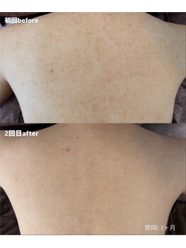 ライフ美容整体院 恵比寿(Life美容整体院)/背中ハーブピーリング