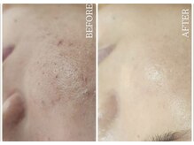 リセラージュ(Recellage)/毛穴洗浄×グロッティ