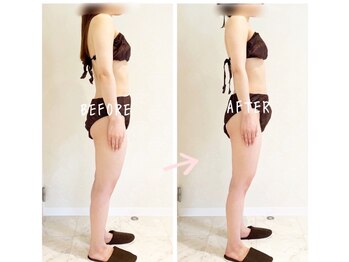 デジール(DESIR)/施術1回のbefore&after