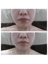 ブランシェ 金沢店 × 椿/シワ・たるみケア　お客様