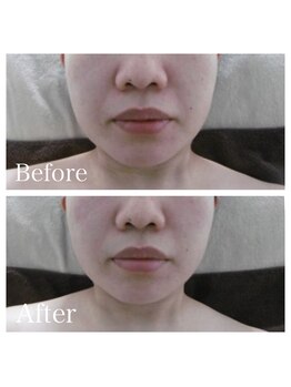 ブランシェ 金沢店 × 椿/シワ・たるみケア　お客様