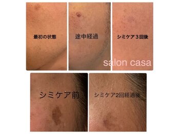 サロン カーサ(Salon Casa)/シミケアビフォーアフター