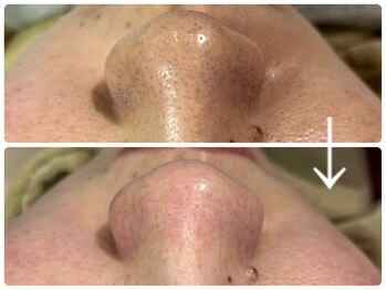 ニコ(Nico)/毛穴エクストラクション