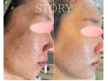 ストーリー(STORY)/ハーブピーリング専門店STORY