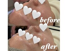 リリーミー(Rily Me)/HyPeel毛穴フェイシャル