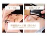 ¥10000→¥1980 美容鍼よりダーマ鍼　今だけお試しキャンペーン！