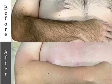 メンズオージー 岡山中区(men's O.G)/メンズ脱毛｜両腕脱毛