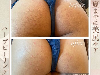 ラナ(LaNa)/お尻ケアで美尻に