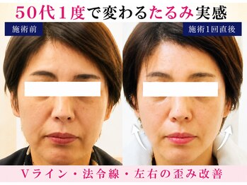 サロンドエステケイワイ(de KY)の写真/劇的結果に自信!【小顔&たるみ改善】背中~肩甲骨から根本改善★プラセンタ+臍帯エキス+ビタミンC導入まで