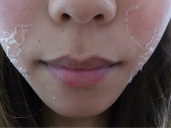 マリー エクラン/ハーブピーリング