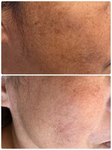 ブリリアント(Brilliant)/シミ、黒ずみ改善