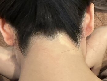 ビューティ ケア ルーム メロウ(Beauty Care Room Moelleux)/左右対象の綺麗なうなじ脱毛♪