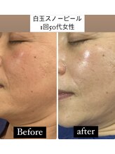 リジュベネ(rejuvena)/白玉スノーピール結果写真