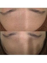 ギャラクシービューティー(galaxy beauty)/プラズマシワケア