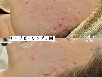ワイシーハッチ(yc.hacci)の写真/速効性・持続力◎ダウンタイム/剥離なし!REVIのハーブピーリングで憧れのうる艶美肌へ*ドライヘッドスパも!