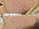 ワイシーハッチ(yc.hacci)の写真/速効性・持続力◎ダウンタイム/剥離なし!REVIのハーブピーリングで憧れのうる艶美肌へ*ドライヘッドスパも!