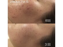 アムズ(Am’s)の雰囲気（【ララピール×LDM】肌質改善ニキビケア）