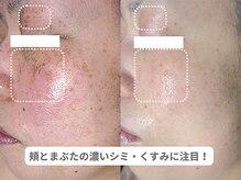 ピュアノア 垂水店/肌質改善フェイシャル　神戸垂水