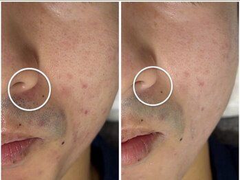 アンリミット 鹿児島天文館店(Une limit)/赤みケア