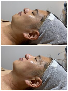 フィフ(fif)/カーボキシーで浮腫もスッキリ！