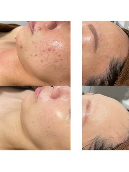 ナチュレ(Nature)/長年の肌悩み、もう終わり！