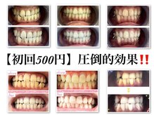 セルフホワイトニングサロン　エクシアホワイトニング宇治小倉店/ビフォーアフター