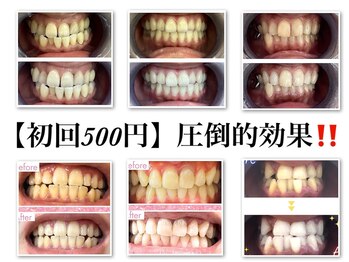 セルフホワイトニングサロン　エクシアホワイトニング宇治小倉店/ビフォーアフター