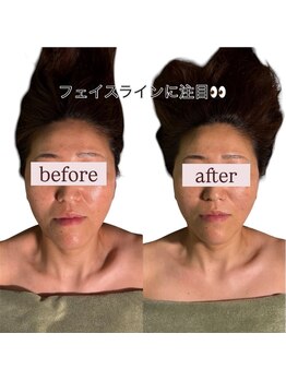 スカイ(sky)/頭蓋骨立体小顔矯正