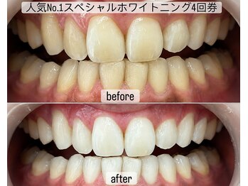 ヤット 森ノ宮(yatto.)の写真/都度払いメニューもご用意◎歯科衛生士によるホワイトニング施術で自信に満ち溢れた笑顔を♪