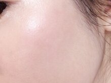 アキレイ(AKILEY)/