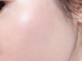 アキレイ(AKILEY)/