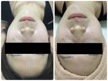 メイユール(MEILLEUR)/光フェイシャル1回＋スキンケア