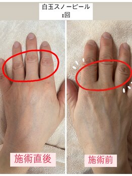 リジュベネ(rejuvena)/白玉スノーピールコースは手も込