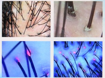 サナス(sanace)/頭皮診断