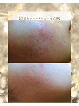 スノースキン(Snow skin)/ニキビケア/ハーブピーリング