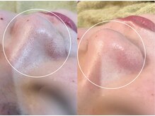 アンベリール(Embellir)/毛穴レスな肌に☆