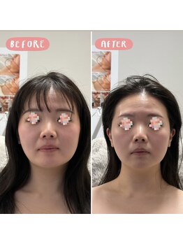 スリーアイ 天王寺店(3EYE)/小顔スペシャルビフォーアフター