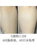 【新規女性/肌管理しながら身体も毛穴レス◎】顔無・VIO込全身脱毛体験¥5,980