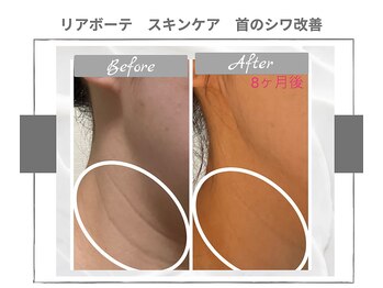 ラ ルーチェ 星田/リアボーテ　スキンケアの効果