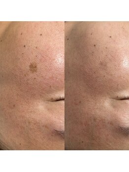 ウル(Ulu)/大きなシミも改善できます！