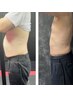 【お腹太もも腕などセル脂肪に!話題の針なし脂肪分解】寝てるだけで確実痩せ