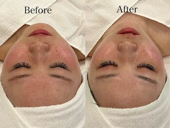 リフコウベ(LIF KOBE)/お肌の赤みはSOSサインです><