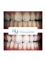 ホワイトニング モア(Whitening MORE)/ビフォーアフター
